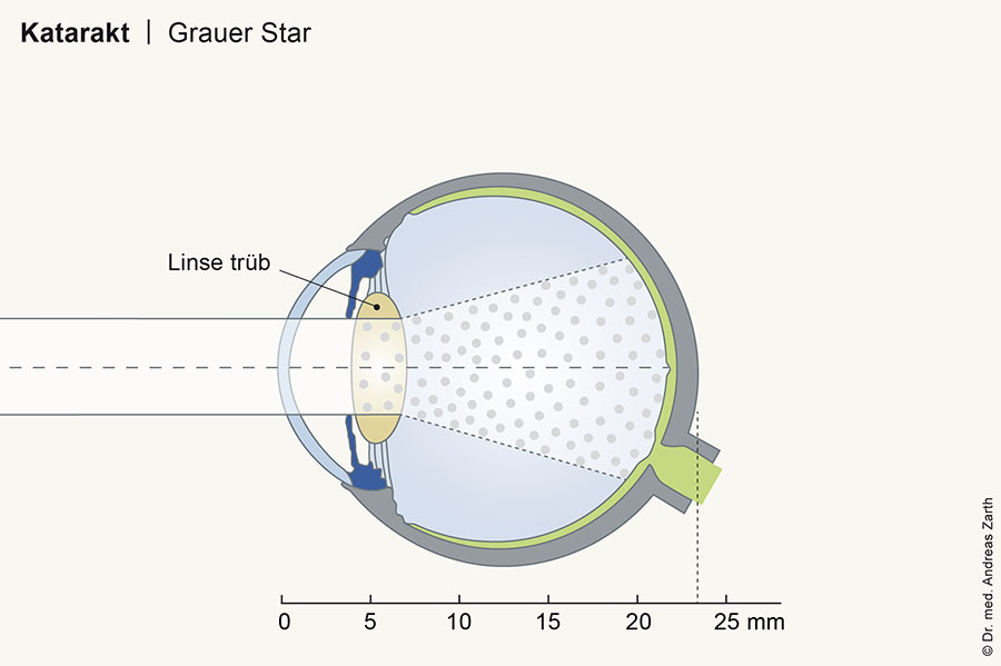 Katarakt Cataract grauer star muenchen 01 2 - Cataract (Grauer Star)