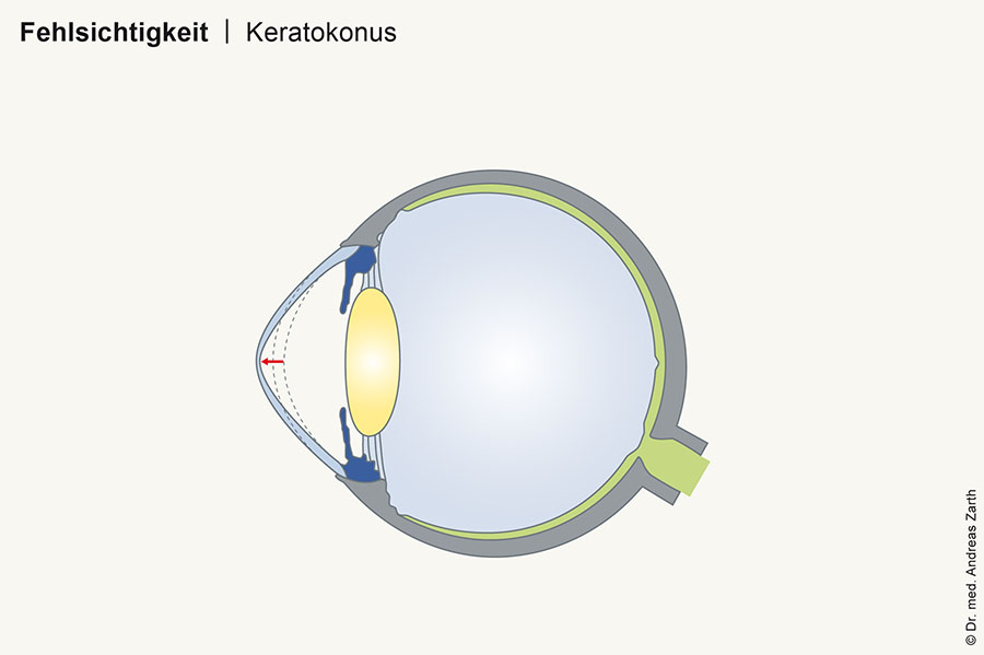 Keratokonus hornhautkegel kontaktlinsen muenchen - Keratokonus