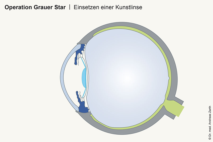 Operation grauer star muenchen 02 Kopie - Cataract (Grauer Star)