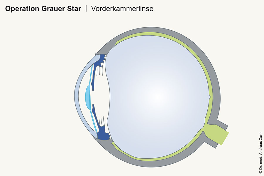 intraokulaere linsen IOP grauer Star muenchen - Intraokularlinsen (IOL)